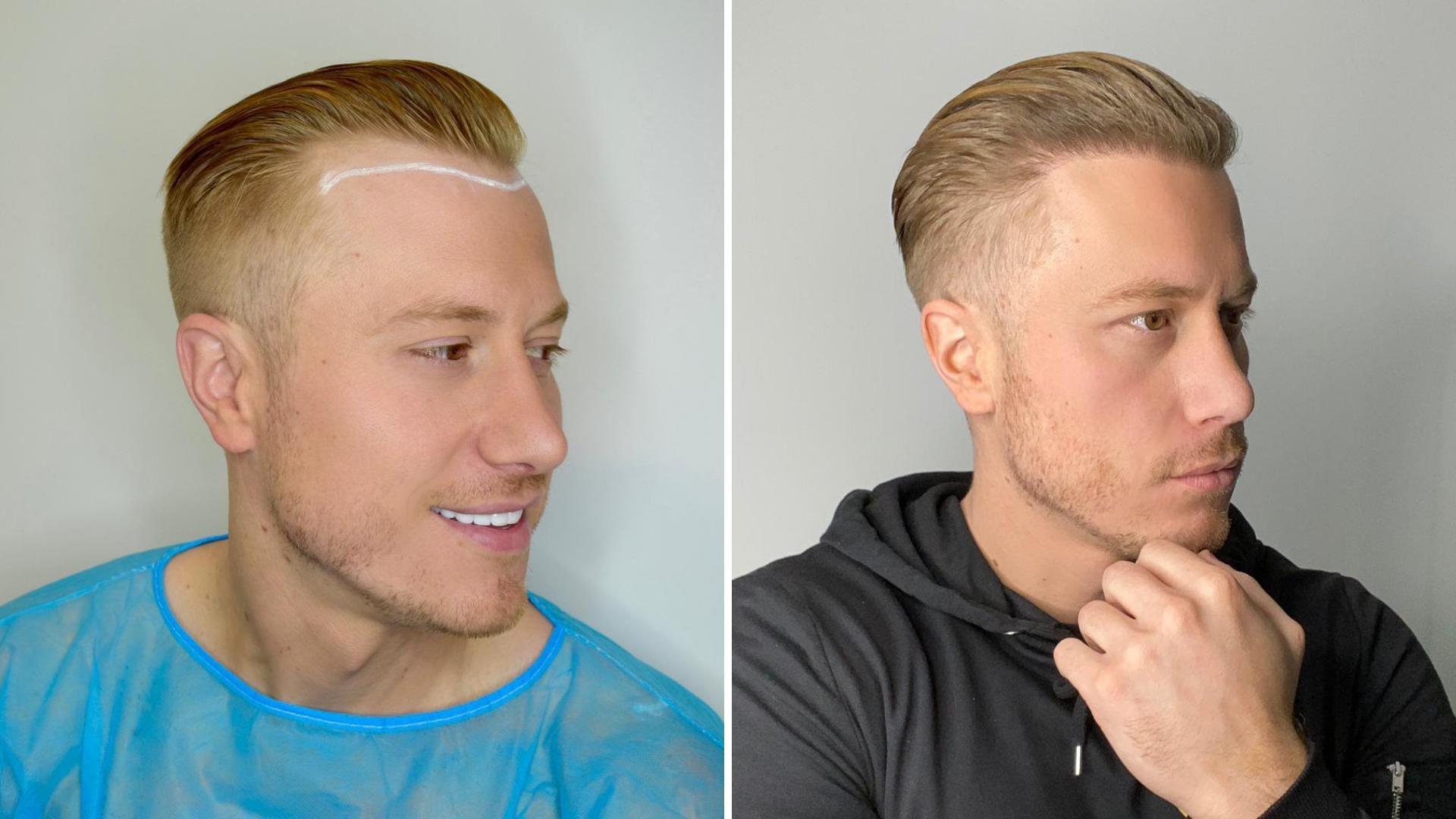 Hair Restoration Recovery